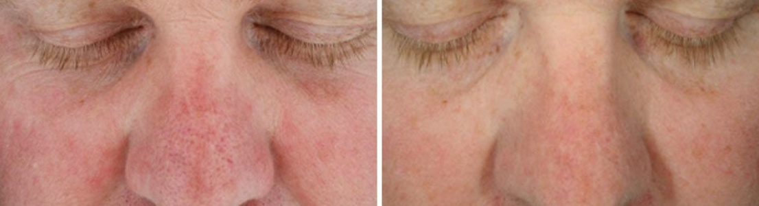 Hydrafacial-4