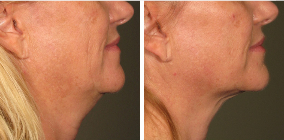 ultherapy-4