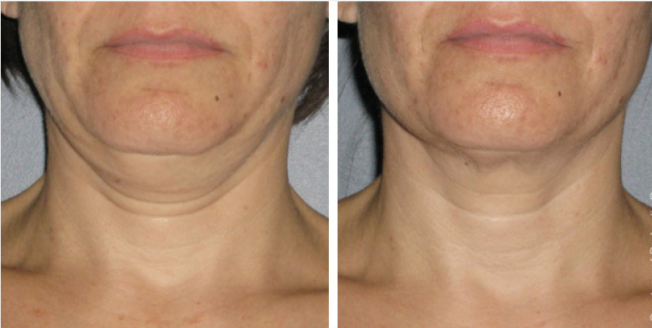 ultherapy-5